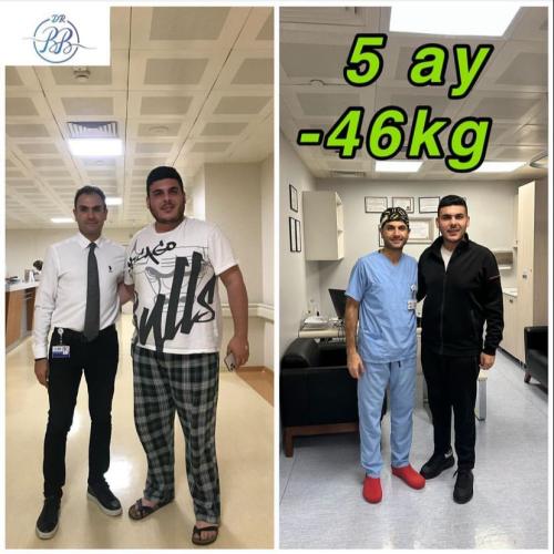 تكميم المعدة صور ماقبل / ما بعد